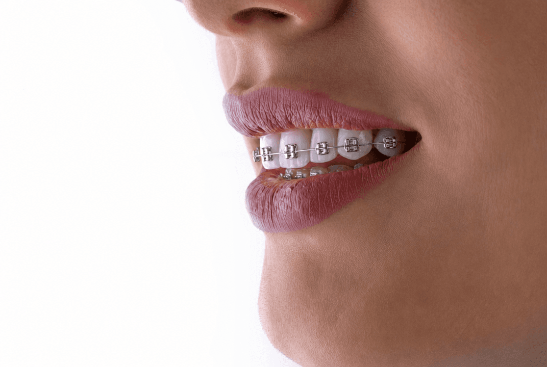 AI Braces Filter